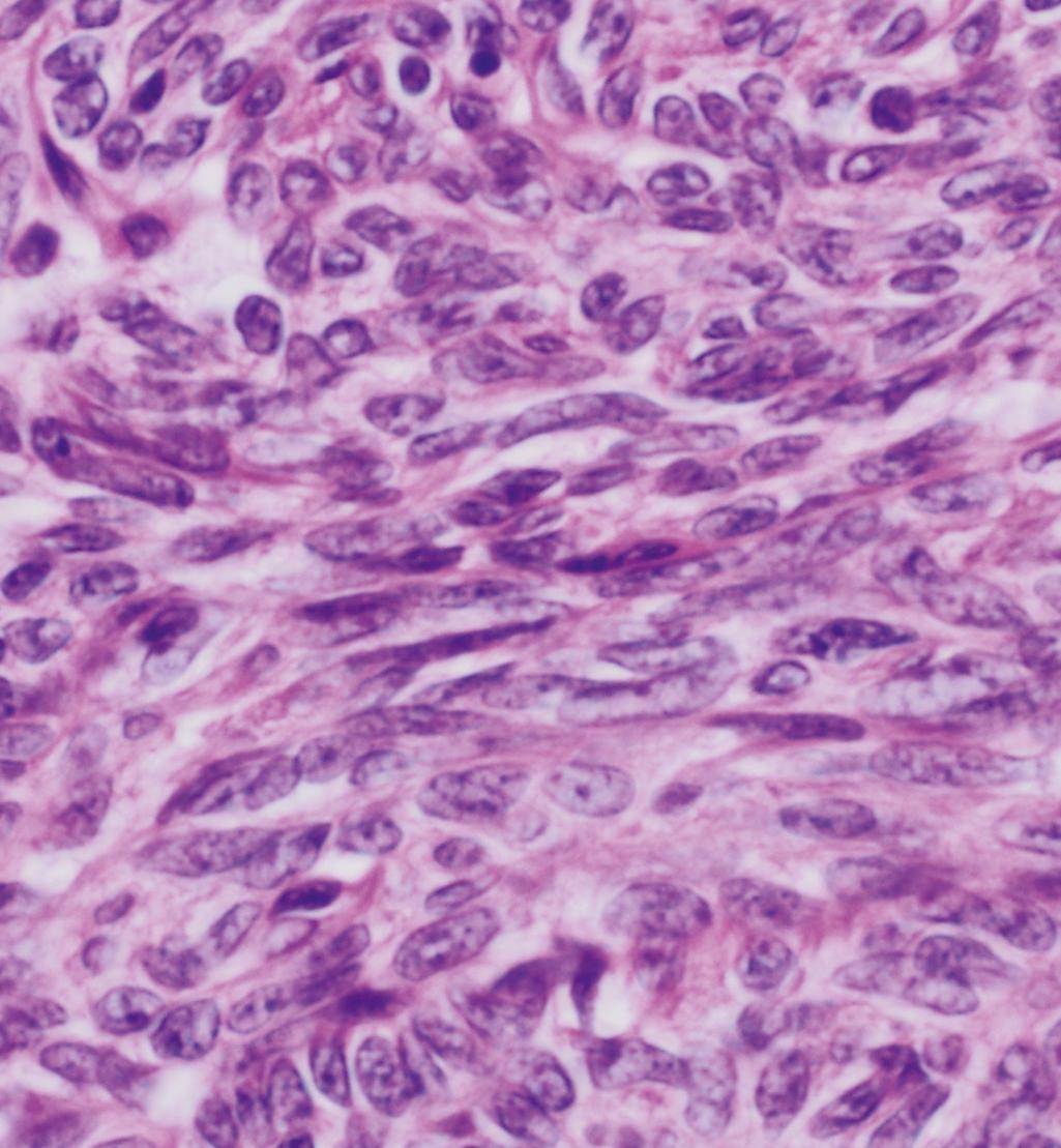 Figure 5.3, Thymoma type A.