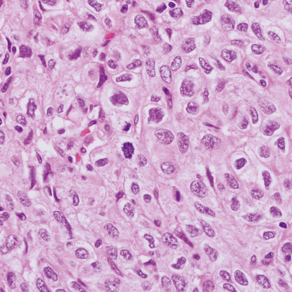 Figure 5.6, Thymoma type B3.