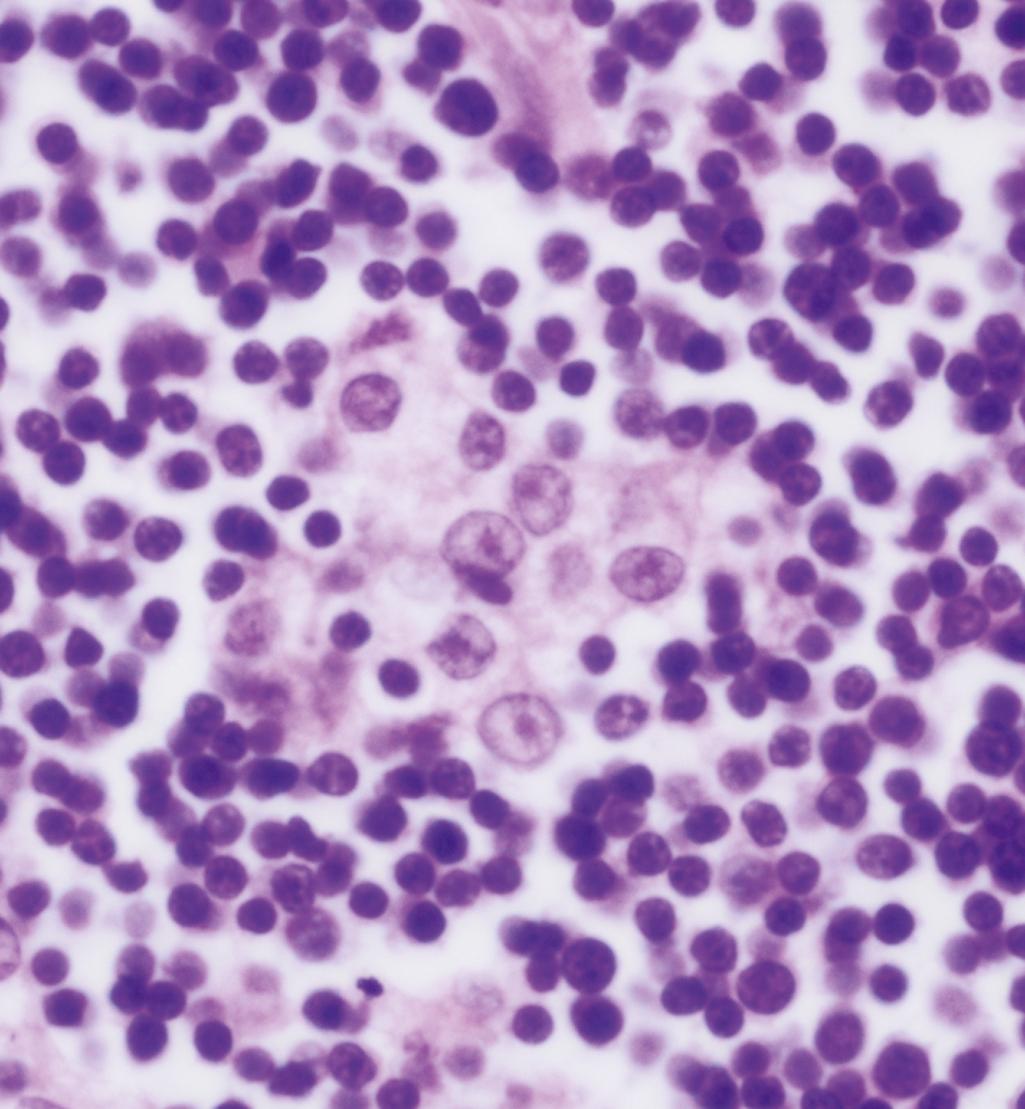 Figure 5.4, Thymoma type B1.