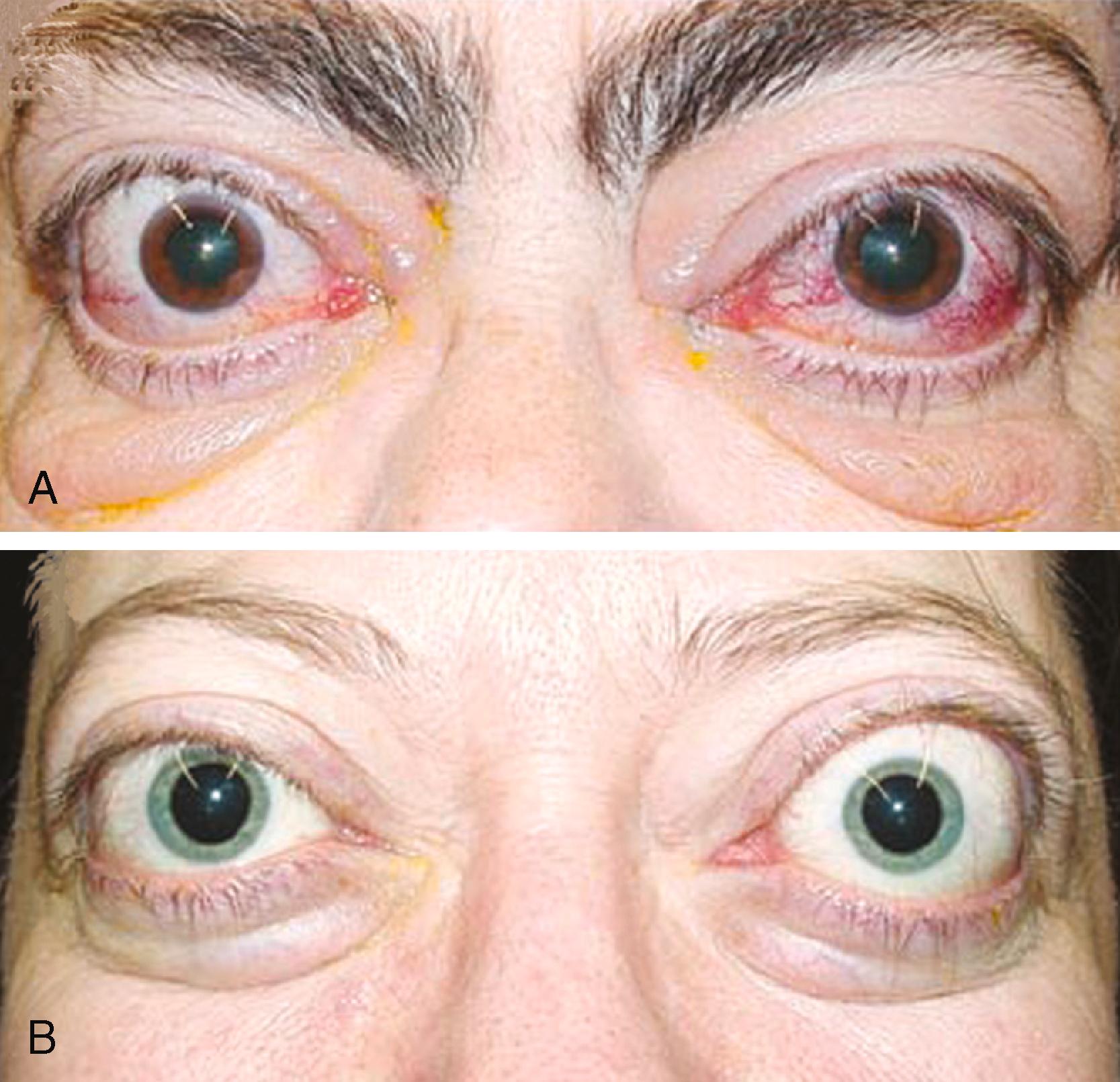 FIGURE 207-2, Graves ophthalmopathy.