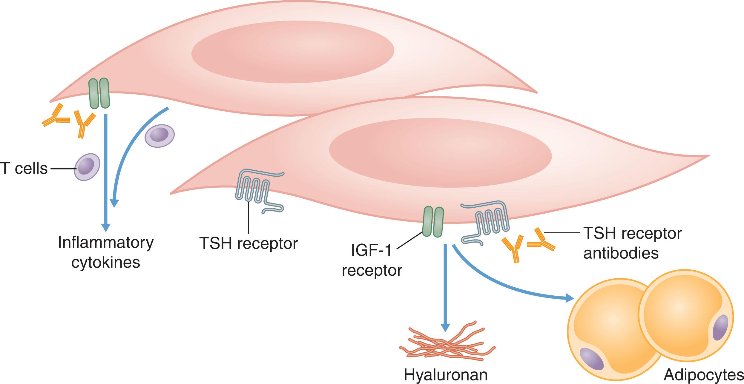 Fig. 12.13.1, Binding of Autoantibodies to Thyroid-Stimulating Hormone Receptor (TSH-Rs) on Fibroblasts Leads to Activation of T Helper Cells, Secretion of Inflammatory Cytokines, and Production of Hyaluronan.