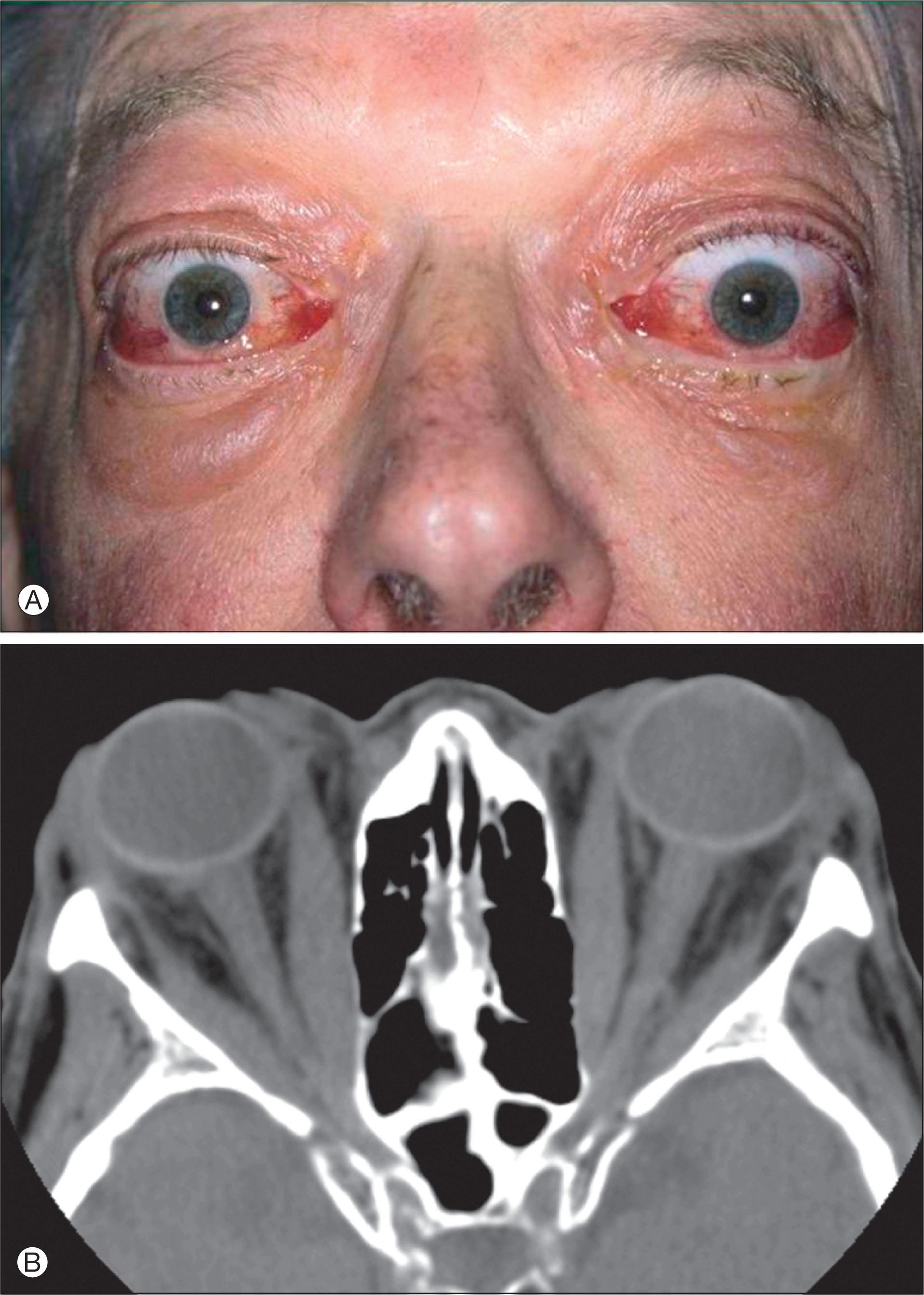 Fig. 12.13.3, (A) Older man shows periorbital soft tissue congestion associated with restricted ocular movements and dysthyroid optic neuropathy. (B) Axial computed tomography scan of same patient shows enlargement of muscles with proptosis and apical crowding.