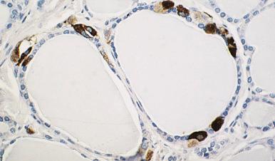 Figure 8.1, Immunoreactivity for calcitonin in thyroid C cells from a case of C-cell hyperplasia.