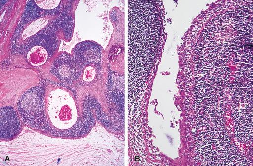 Figure 8.13, A and B, Hashimoto thyroiditis with branchial cleftlike cysts. In the high-power microphotograph ( B ) one can appreciate the infiltration by the lymphocytes of the lining epithelium.