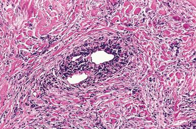 Figure 8.15, Inflammation of a vein in Riedel thyroiditis.