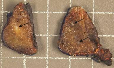 Figure 8.16, Multifocal sclerosing thyroiditis, macroscopic appearance. Multiple fibrotic foci are scattered throughout the bisected thyroid lobe (arrows) .