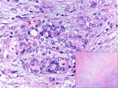 Figure 8.17, Multifocal sclerosing thyroiditis, microscopic appearance. Reactive atypia of follicular cells and “nodular fasciitis-like” stroma. The inset shows the irregular starlike fibrotic focus at low power.