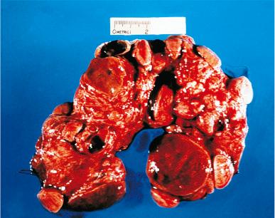 Figure 8.18, Dyshormonogenetic goiter. Gross appearance. Note the multinodular quality and the hemorrhagic changes in the larger nodules.