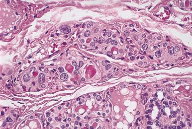 Figure 8.19, Dyshormonogenetic goiter. Microscopic appearance. The follicles are hyperplastic and lined by follicular cells with marked nuclear pleomorphism.