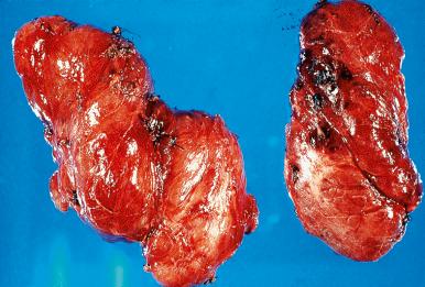 Figure 8.20, Outer aspect of diffuse thyroid hyperplasia in a patient with Graves disease. The gland is diffusely swollen and hyperemic.