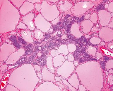 Figure 8.2, Solid cell rest. The irregular branching shape of the nodule is characteristic.