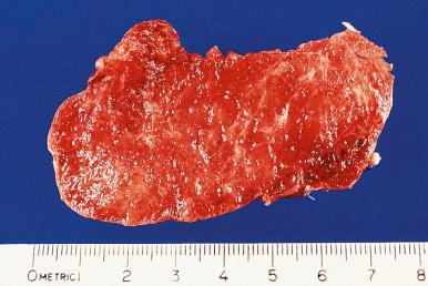 Figure 8.21, Cut surface of thyroid gland with diffuse hyperplasia, showing a hyperemic “juicy” appearance.