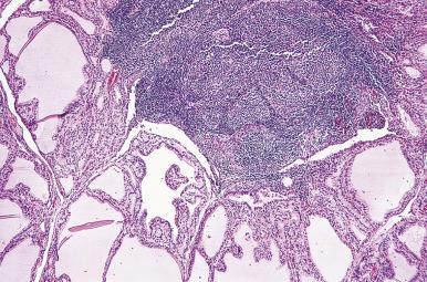 Figure 8.23, Lymphoid follicles with germinal centers and hyperplastic thyroid follicles in diffuse hyperplasia. Note the pale-staining quality of the colloid.