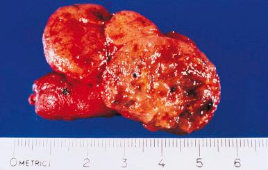 Figure 8.24, Nodular hyperplasia of thyroid gland, with secondary cystic and hemorrhagic areas.