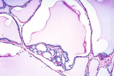 Figure 8.26, Nodular hyperplasia showing so-called Sanderson polster.