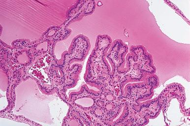 Figure 8.27, Nodular hyperplasia with benign papillary formations protruding toward the center of a cystically dilated follicle. Note the basal position of the nuclei.