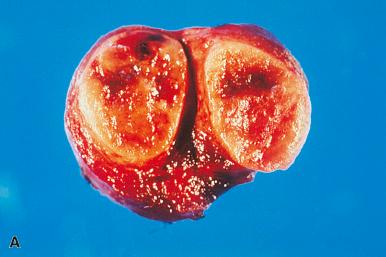 Figure 8.28, A and B , Gross appearance of two follicular adenomas. Both tumors show focal hemorrhagic areas.