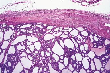 Figure 8.29, Intact fibrous capsule around a follicular adenoma.