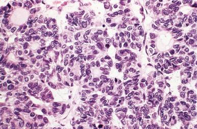 Figure 8.30, Microfollicular pattern of growth in a follicular adenoma.