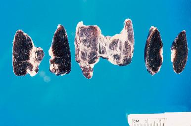 Figure 8.3, Black thyroid following minocycline therapy.