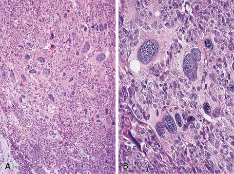 Figure 8.31, Low-power (A) and high-power (B) views of follicular adenoma with bizarre nuclei. This feature is not a sign of malignancy and is analogous to that seen in many other endocrine tumors.