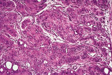 Figure 8.32, Low-power view of hyalinizing trabecular adenoma.