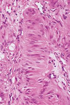 Figure 8.33, Hyalinizing trabecular adenoma. A wide trabecula is seen in the center of the picture, with the tumor cells arranged perpendicular to the longest axis.