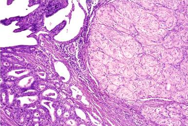 Figure 8.35, Typical hyalinizing trabecular adenoma pattern (right) , and a lesion with the features of a papillary carcinoma (left) are seen side by side, in a cervical lymph node metastasis.