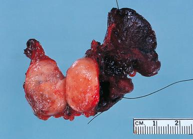 Figure 8.36, Gross appearance of a papillary carcinoma.