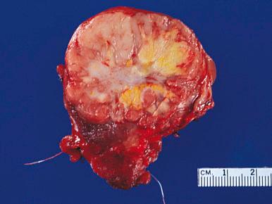 Figure 8.37, Gross appearance of a papillary carcinoma. The tumor shown exhibits a central area of fibrosis.