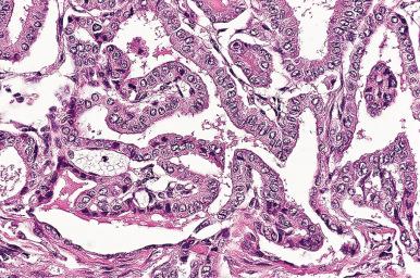Figure 8.38, Complex branching papillae in classic papillary carcinoma.