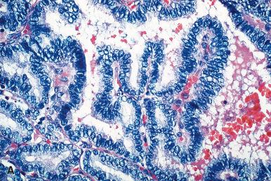 Figure 8.39, Nuclear features of papillary carcinoma: A, optically clear nuclei; B, nuclear pseudoinclusions.