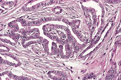 Figure 8.40, Desmoplastic stromal reaction in papillary carcinoma.