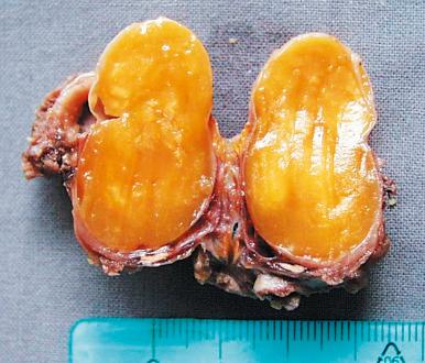 Figure 8.4, Thyroglossal duct cyst. The content of the cyst is gelatinous.