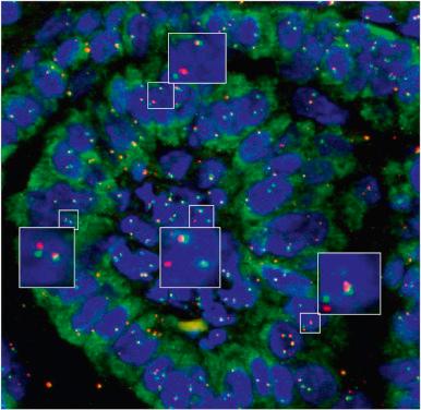 Figure 8.43, Papillary thyroid carcinoma with RET/PTC rearrangement visualized using fluorescent probes that cover the RET locus at 10q11.2. Split fluorescent in situ hybridization signals indicating RET rearrangement are highlighted and magnified in the square insets.