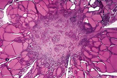 Figure 8.44, Typical stellate appearance of papillary microcarcinoma.