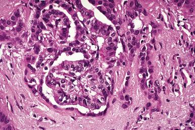 Figure 8.45, On high power, the appearance of papillary microcarcinoma is no different from that of its larger counterpart.