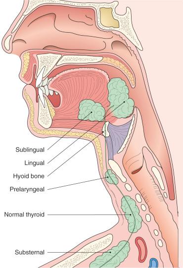 Figure 8.5, Distribution of heterotopic thyroid tissue.