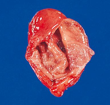 Figure 8.6, Branchial cleft cyst that has been partially opened to expose the inner surface, which is rendered irregular by the presence of innumerable hyperplastic lymphoid follicles.