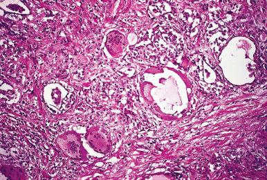 Figure 8.7, Granulomatous thyroiditis showing multiple granulomas centered in thyroid follicles.