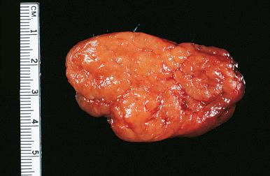 Figure 8.9, Cut surface of thyroid involved by Hashimoto thyroiditis. The appearance is reminiscent of a hyperplastic lymph node.