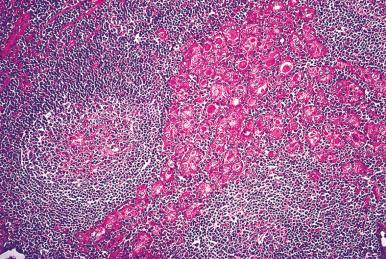 Figure 8.10, Hashimoto thyroiditis showing lymphoid follicles with prominent germinal centers and oncocytic follicular epithelium.