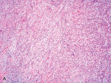 Fig. 29-11, Post-FNAB spindle cell nodule in an adenomatoid nodule.