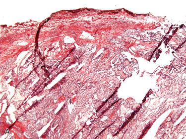 Fig. 29-12, Intraoperative consultation, papillary thyroid carcinoma usual type.