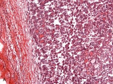 Fig. 29-13, Intraoperative consultation, papillary thyroid carcinoma (PTC), follicular variant.