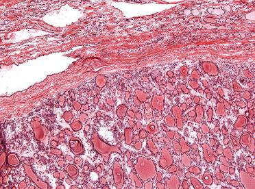 Fig. 29-14, Intraoperative consultation, follicular adenoma.