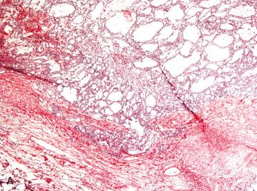 Fig. 29-15, Intraoperative consultation, follicular carcinoma minimally invasive.