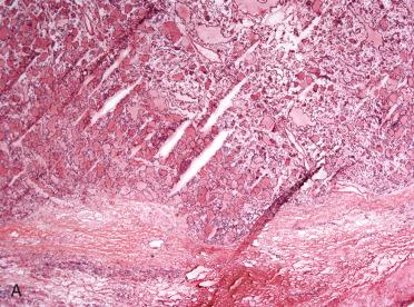 Fig. 29-17, Intraoperative consultation, capsular pseudoinvasion in a follicular adenoma.