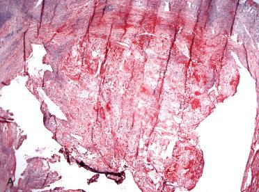 Fig. 29-18, Intraoperative consultation, adenomatoid nodules.