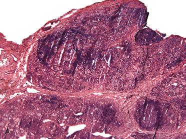 Fig. 29-19, Intraoperative consultation, chronic lymphocytic (Hashimoto) thyroiditis.